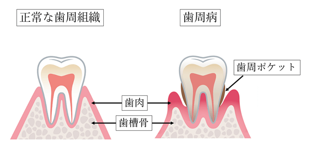 そもそも歯周病とはどのような病気でしょうか