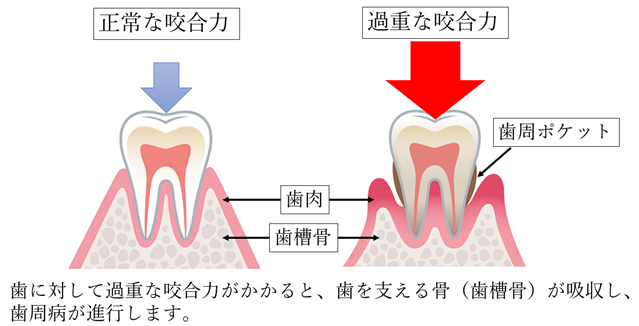 噛み合わせが原因の場合