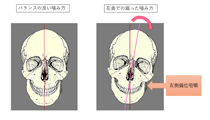 咬合関連症の原因は何でしょうか