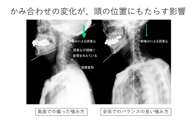 噛み合わせの悪さと全身症状はどう関係しているのでしょうか